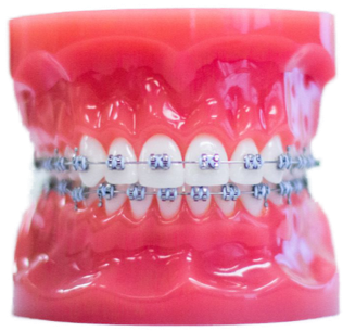 Metal Braces