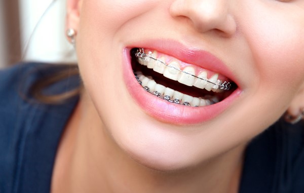 Types of Braces in Martinsburg WV