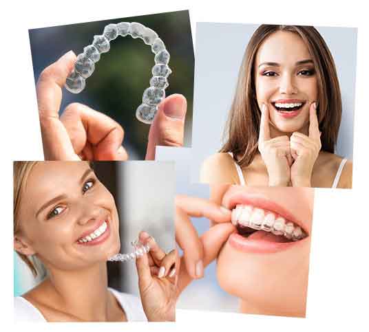opt-younis-invisalign