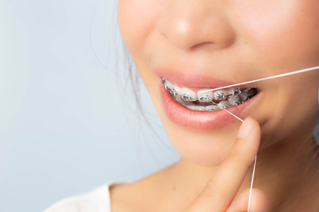Best Practices for Keeping Braces Clean